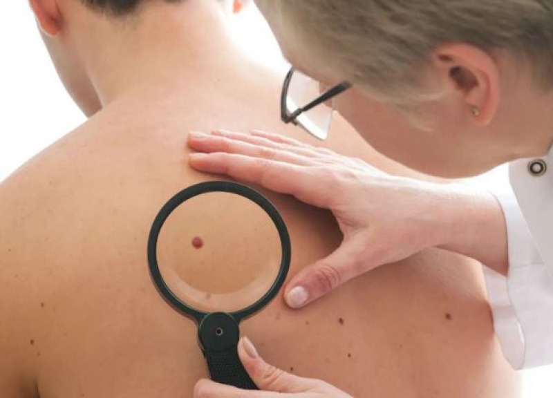 Refuerzan controles para prevenir cncer de piel